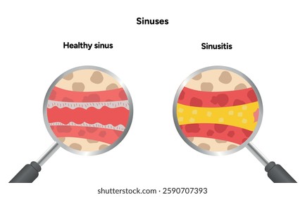 Sinuses anatomy healthy sinus and sinusitis. Nose nasal anatomy. Inflammation Nasal Cavity