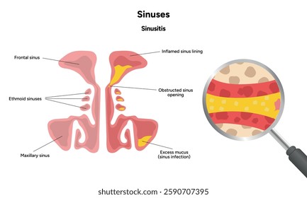 Sinuses anatomy healthy sinus and sinusitis. Nose nasal anatomy. Inflammation Nasal Cavity