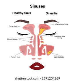 Sinuses anatomy sinusitis. Nose nasal anatomy. Inflammation Nasal Cavity