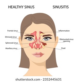 Sinusitis,  Female face with inflammation of the mucous membrane of the paranasal and frontal sinuses. Vector illustration for medical posters and educational materials