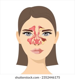 Sinusitis, weibliches Gesicht mit Entzündung der Schleimhaut der paranasalen und frontalen Nebenhöhlen. Vektorgrafik für medizinische Poster und Lehrmaterialien