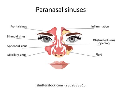 Sinusitis, weibliches Gesicht mit Entzündung der Schleimhaut der paranasalen und frontalen Nebenhöhlen. Vektorgrafik für medizinische Poster und Lehrmaterialien