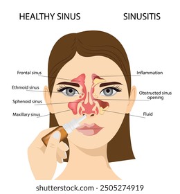 Sinusitis,  Female face with inflammation of the mucous membrane of the paranasal and frontal sinuses, nasal drops. Vector illustration for medical posters and educational materials