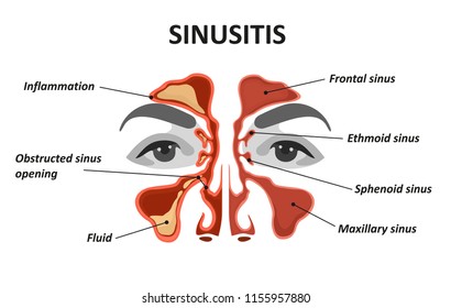 Sinusitis. Healthy and inflammation nasal sinus