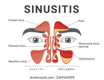 Sinusitis healthy and inflammatory educational medical infographic scheme banner vector flat illustration. Breath sounds ducts nose drain respiratory disease and treatment anatomy science healthcare