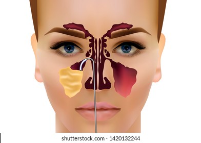 Sinusitis. Healthy and inflammatory sinus. breath sounds. Arrow the ducts of the nose to drain the pus Spitz
