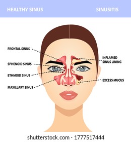 4,227 Healthy sinus Images, Stock Photos & Vectors | Shutterstock