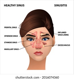 Sinusitis Healthy Sinus Infections Signs Realistic Stock Vector ...