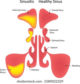 Sinusitis Healthy Sinus Science Design Vector Illustration Diagram