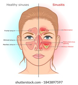 Sinusitis infection and normal sinuses medical diagram. 