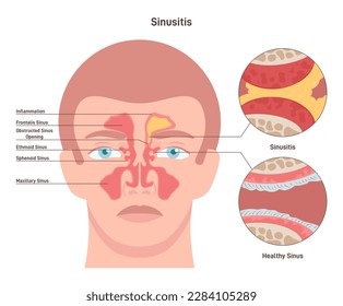 Sinusitis. Inflamed sinus with excess mucus and obstructed airways. Infectious inflammatory disease or allergy symptom. ENT or otolaryngology banner. Flat vector illustration