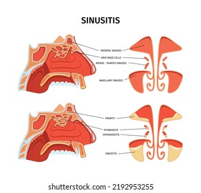 Sinusitis infographics cross section poster depicting inflammation of paranasal sinuses including maxillary frontal and grid maze cells realistic vector illustration