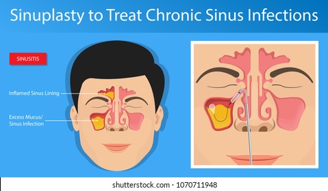 Sinusitis Medical Disease Treat Sinuses Allergies Stock Vector (Royalty ...