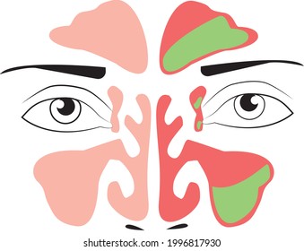 Sinusitis medical treatment. Healthy and inflammation sinus. Nasal diseases. Sinusitis, sinus infection diagnosis  medical infographic design. Otolaryngology concept. Isolated on white. Vector Eps 8