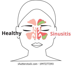 Sinusitis medical treatment. Healthy and inflammation sinus. Nasal diseases. Sinusitis, sinus infection diagnosis  medical infographic design. Otolaryngology concept. Isolated on white. Vector Eps 8