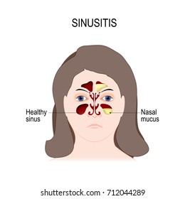 Sinusitis. Sinus infection is inflammation of the sinuses. rhinosinusitis