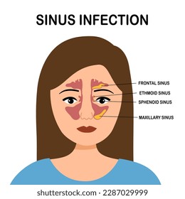 Sinusitis or sinus infection infographic in flat design on white background.