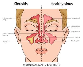 Diagrama de estructura de sinusitis dibujado a mano ilustración vectorial esquemática. Ilustración educativa de ciencias médicas