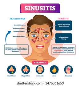 Sinusitis vector illustration. Labeled rhinosinusitis inflammation scheme. Anatomical explanation with healthy and infection nasal illness comparison, symptoms list and educational disease infographic