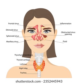 Sinusitis, weibliches Gesicht mit Entzündung der Schleimhaut der paranasalen und frontalen Nebenhöhlen. Vorderer Blick auf die Schilddrüse und die Trachea auf weißem Hintergrund. Anatomie der Organe des menschlichen Körpers