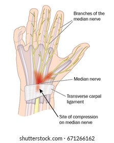 Site of compression of the median nerve in carpal tunnel syndrome.