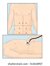 Sites of abdominal vascular sounds when performing abdominal auscultation with a stethoscope