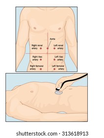 Sites of abdominal vascular sounds when performing abdominal auscultation with a stethoscope