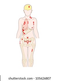 Sites of breast cancer metastatic spread, to the lung, brain, liver bone and other sites