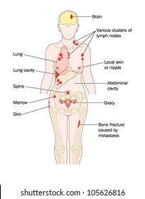 Sites of breast cancer metastatic spread, to the lung, brain, liver bone and other sites