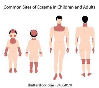 Sites of eczema