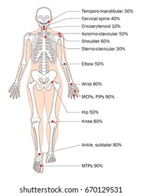 Sites of rheumatoid arthritis and relative frequency.