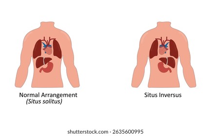 Situs inversus vector illustration. Mirrored organs	