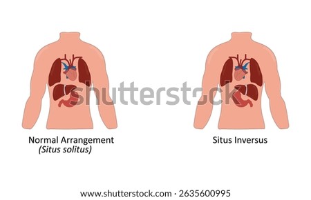 Situs inversus vector illustration. Mirrored organs	