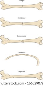 Six Types Bone Fracture Vector Different Stock Vector (Royalty Free ...