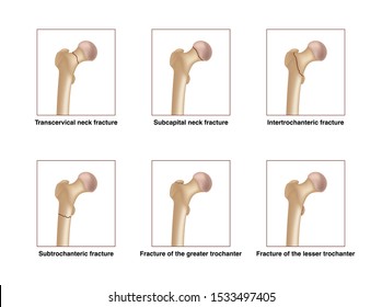 Six types of femoral neck fracture. Realistic drawing showing broken bone with inscriptions isolated on whie background.