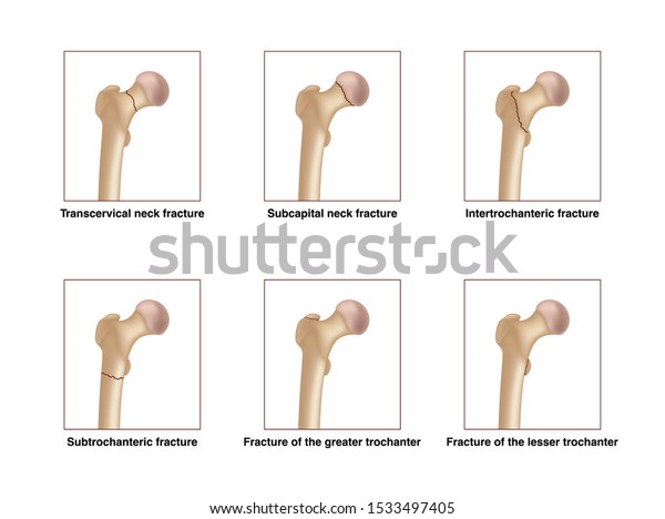 femoral neck fracture complications