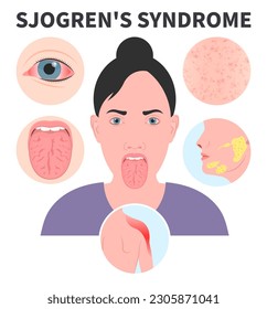 Sjogren's Syndrome dry eye Lymph nodes redness saliva sialadenitis Intraoral halitosis Burning Fissured Difficulty swallowing Fissured throat skin Cracked sore tongue