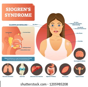 Sjogrens syndrome vector illustration. Dry body autoimmune disease. Labeled medical explanation with moisture producing glands. Symptoms, diagnosis and consequences.