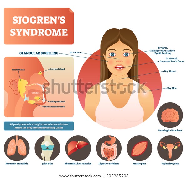 Sjogrens Syndrome Vector Illustration Dry Body Vector C S N Mi N Ph   Sjogrens Syndrome Vector Illustration Dry 600w 1205985208 