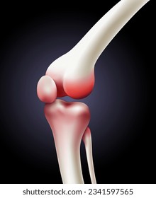 Skeletal flexion at the knee joint showing the cause of painful osteoarthritis. vector illustration file.