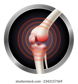 Skeletal flexion at the knee joint showing the cause of painful osteoarthritis. vector illustration file.