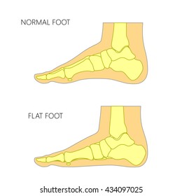 Skeletal illustration of a normal foot and a flat foot.