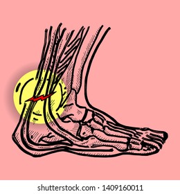 Skeletal structure of a human feet with pain symbol on the Achilles heel. Hand drawn vector illustration.