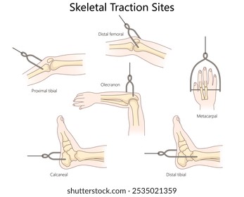 locais de tração esquelética no corpo humano, incluindo tibial proximal, calcâneo e áreas metacárpicas diagrama desenhado à mão ilustração vetorial esquemática. Ilustração educacional de ciências médicas