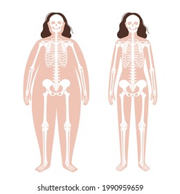 Skeleton system human bones concept. X ray with overweight and normal female silhouette. Skull, arms, legs, knee and foot. Ribs and hand joints. Obese woman body anatomical flat vector illustration.