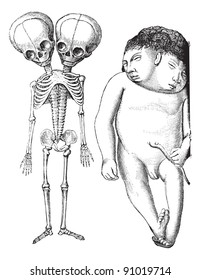 Skeleton of two-headed monster derodyme. (Musee Dupuytren). 2. Iniodyne two-headed monster, vintage engraved illustration. Usual Medicine Dictionary - Paul Labarthe - 1885.