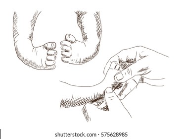 Sketch Of Baby Clubfoot Leg And Doing Treatment In Vector.