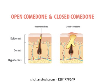 Skin acne comparing with Open Comedone & Closed Comedone condition diagram illustration vector on white background. Beauty concept.