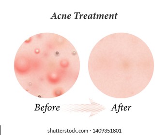 Skin acne treatment before and after. Vector skin acne pimples, facial cleanser and face comsemtic package design