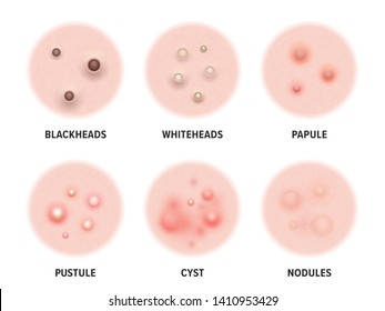 Skin acne types diagram. Vector skin disease pimples blackheads and comedones, cosmetology and skincare problems treatment